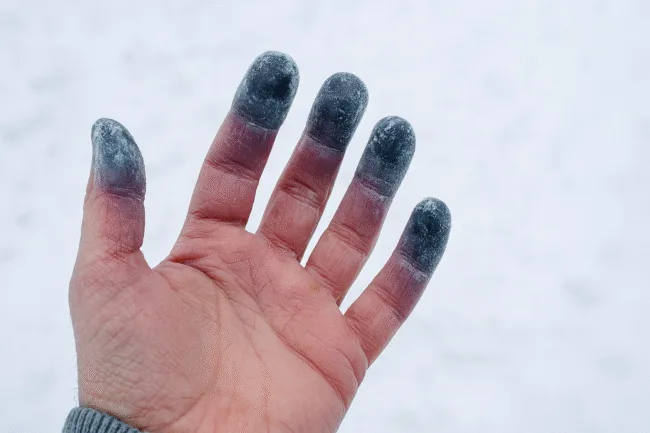 What is frostbite and how is it medically treated in extreme cold