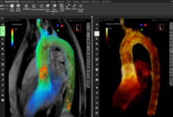 Cardio Flow Design gets FDA approval for iTFlow software for enhanced cardiovascular diagnosis