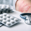 Representative image of oral psoriasis treatment, illustrating Takeda Pharmaceutical Company Limited’s zasocitinib Phase 3 results and the growing competition in once-daily plaque psoriasis pills.