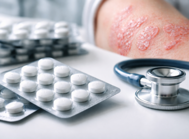 Representative image of oral psoriasis treatment, illustrating Takeda Pharmaceutical Company Limited’s zasocitinib Phase 3 results and the growing competition in once-daily plaque psoriasis pills.
