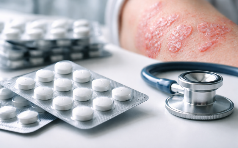 Representative image of oral psoriasis treatment, illustrating Takeda Pharmaceutical Company Limited’s zasocitinib Phase 3 results and the growing competition in once-daily plaque psoriasis pills.