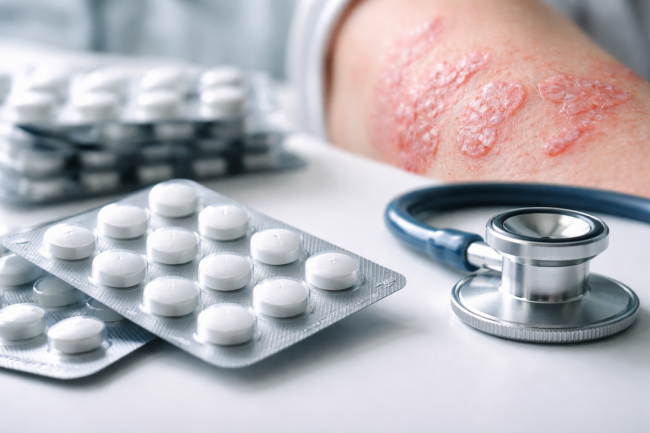 Representative image of oral psoriasis treatment, illustrating Takeda Pharmaceutical Company Limited’s zasocitinib Phase 3 results and the growing competition in once-daily plaque psoriasis pills.