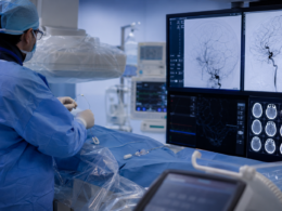 Representative image: A neurointerventional team reviews brain imaging during a stroke thrombectomy procedure, reflecting Penumbra’s THUNDERBOLT FDA clearance and the growing role of computer assisted vacuum thrombectomy in acute ischemic stroke treatment.