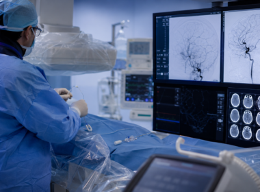 Representative image: A neurointerventional team reviews brain imaging during a stroke thrombectomy procedure, reflecting Penumbra’s THUNDERBOLT FDA clearance and the growing role of computer assisted vacuum thrombectomy in acute ischemic stroke treatment.