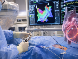 Pulsed field ablation is emerging as a major new approach to atrial fibrillation treatment, using short electrical pulses instead of heat or freezing as medtech companies race to reshape cardiac ablation. Representative image.