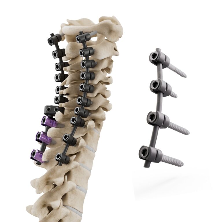 icotec’s CMORE CT posterior cervicothoracic stabilization system can now qualify for a Medicare new technology add-on payment of up to $60,905 per eligible inpatient case.
